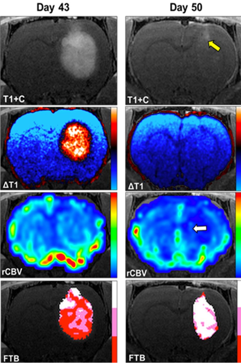 Advanced MRI Brain Cancer Tumor - پیشرفت در درمان نوآورانه ای که سلول های سرطانی را 