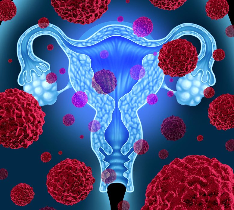 Uterine Endometrial Cancer Therapy Concept 777x699 1 - اضافه وزن خطر ابتلا به سرطان رحم در زنان را تقریبا دو برابر می کند