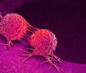 cancer 295x250 - اضافه وزن خطر ابتلا به سرطان رحم در زنان را تقریبا دو برابر می کند